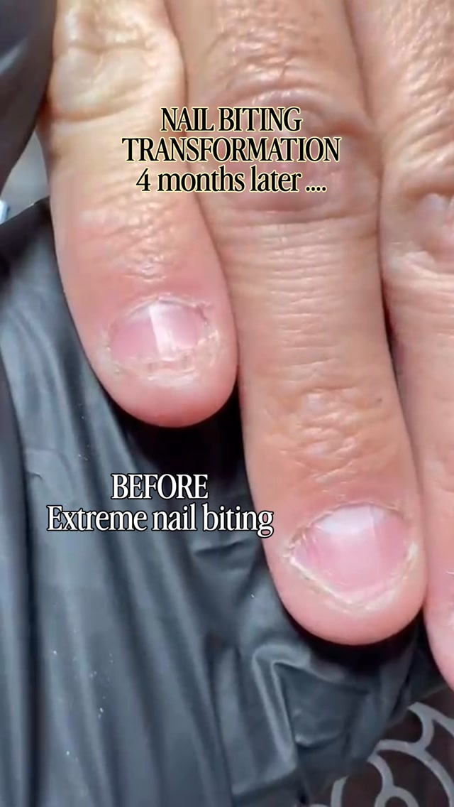 From extreme nail biting to healthy natural nails. 🤯

When he came to me for his first appointment, his nails were extremely bitten and the surrounding skin was heavily affected.

The goal wasn’t just to make his nails look good for one appointment.
It was to protect the natural nails, support healthy growth and help him break the habit of nail biting.

The first session was only the beginning.

4 months later: his natural nails had completely grown out — and he had stopped biting them. 🥹

This is why nail reconstruction is so much more than a beautiful before & after. Sometimes, seeing your hands differently is the first step to changing a habit. 🤍

Would you have expected this result after only 4 months?

nail biting · nail biter transformation · bitten nails · extreme nail biting · nail biting recovery · nail reconstruction · nail correction · natural nail growth · healthy natural nails · nail transformation · before and after nails · Nagelbeißer · Nagelbeißer Behandlung · Nagelbeißer Modellage · Nagelbeißer Nägel · Nagelrekonstruktion · Naturnagel · Naturnagelwachstum · Nageldesign Wien · Russian Manicure · Nail Trainer Vienna · Nail Education

#nailbiting #nailbiter #nailtransformation #nailreconstruction #naturalnail
